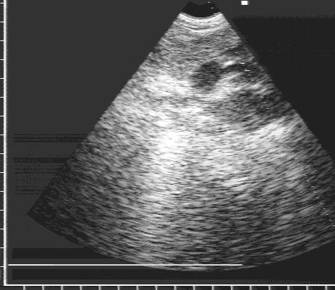 Открытый артериальный проток.