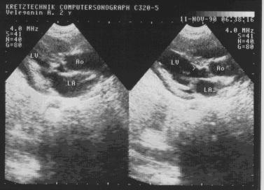 Подклапанный стеноз аорты дискретный фибромышечный.