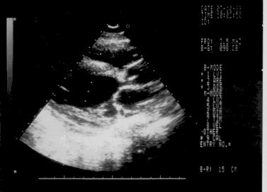 Подклапанный перимембранозный стеноз аорты.