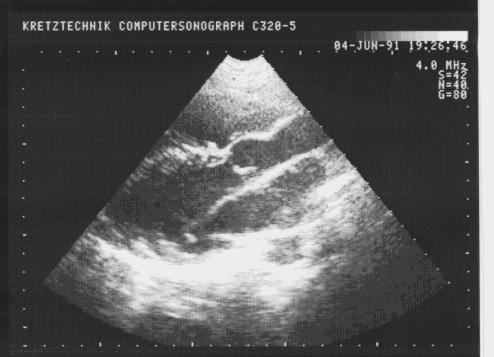 Надклапанный стеноз аорты типа песочных часов.