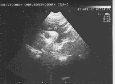 Надгрудинная проекция дуги аорты.