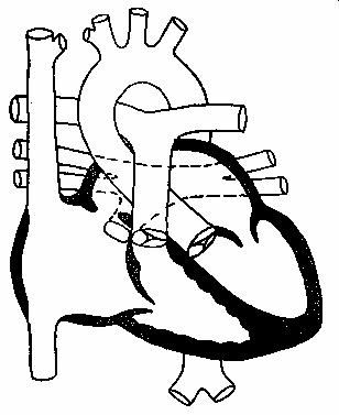 Тотальный аномальный дренаж легочных вен в коронарный
синус. Дефект межпредсердной перегородки.