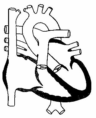 Дефект аортолегочной перегородки.