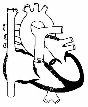 Клапанный стеноз аорты. Постстенотическая дилатация восходящей
аорты.