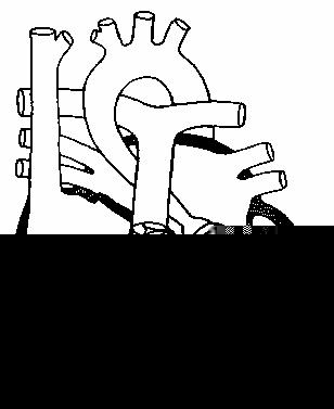 Надклапанный стеноз аорты.